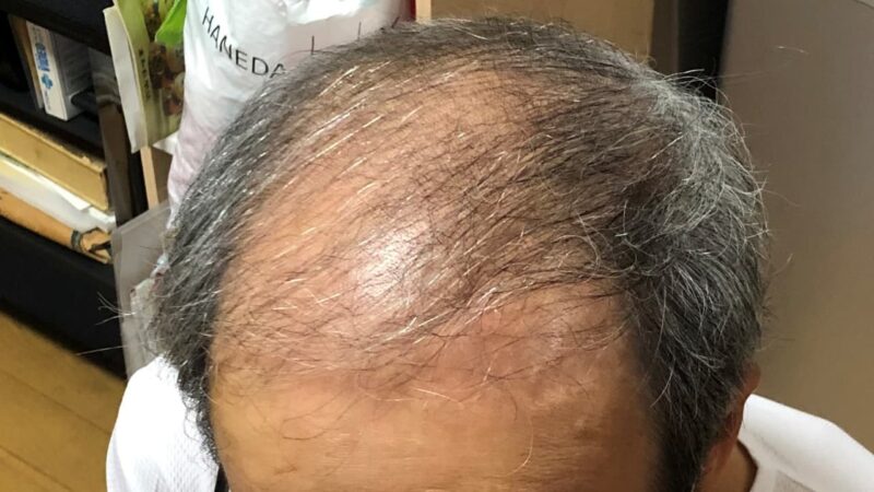 頭皮二酸化塩素水スプレー、およそ１ヶ月後